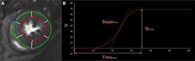 Improvement in coronary microvascular dysfunction evaluated by cardiac magnetic resonance in patients with hypertrophic obstructive cardiomyopathy after transapical beating-heart septal myectomy